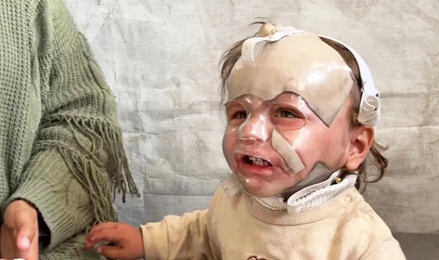 Gazzeli çocuk, katil Netanyahu'nun saldırılarının yol açtığı yanıklarla uğraşıyor