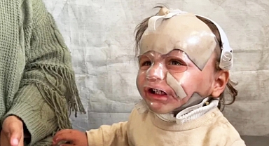 Gazzeli çocuk, katil Netanyahu'nun saldırılarının yol açtığı yanıklarla uğraşıyor