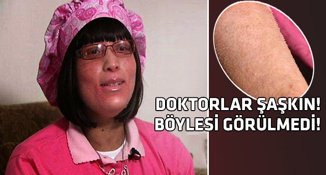 Vücudunda tüy yerine tırnak çıkıyor!