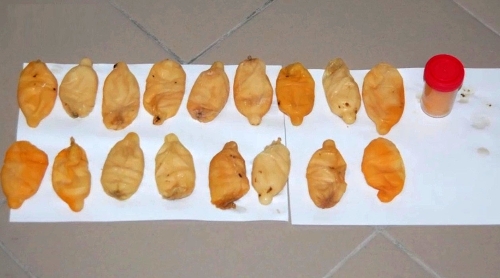 Kolombiyalı papazın midesinden 800 gram kokain çıktı