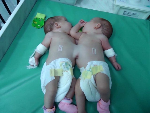 Rusya'da yapışık ikizler başarılı bir operasyonla ayrıldı
